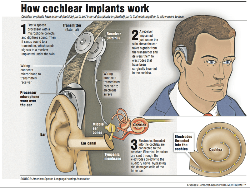 What insurance companies cover cochlear implants